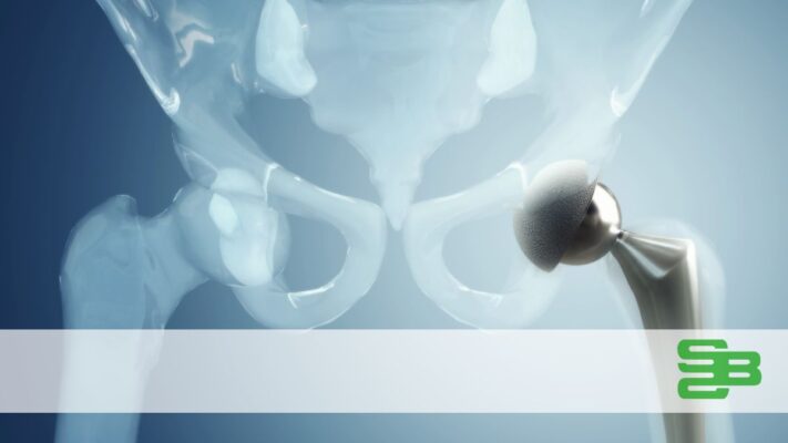 Riabilitazione protesi anca: recuperare in modo completo